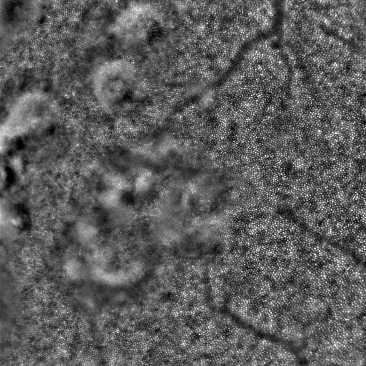 Drusen in a patient with familial drusen. Even small drusen are easily visible due to changes in the cone mosaic. Courtesy K . Gocho, V. Sarda, S. Falah, J.A. Sahel M. Benchaboune, M. Ullern, and M. Paques, Quinze-Vingts National Eye Hospital, Paris, France