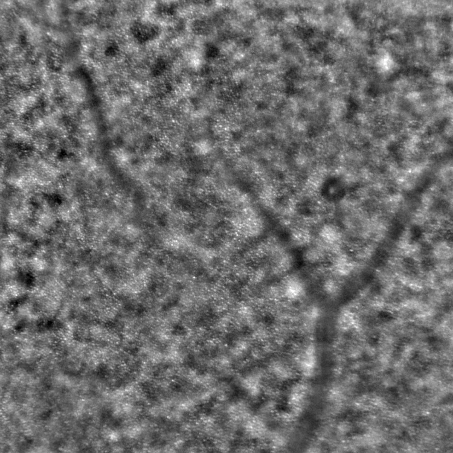 Microaneurism in a diabetic patient. This image was acquired while focusing the rtx1 at the photoreceptor layer. Although the aneurism is slightly out of focus, it is highly visible. Diabetic retinopathy could not be detected by other techniques in this patient. See also the next image gallery. Courtesy Dr Marco Lombardo, Bietti Fundation, Roma, Italy