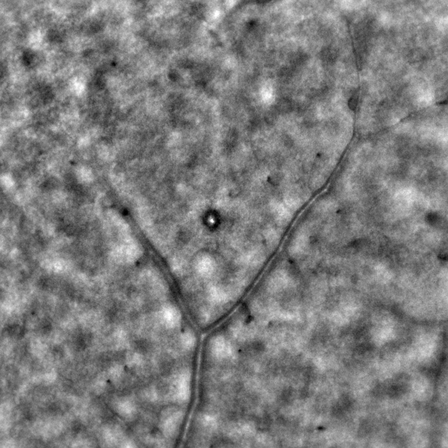 Microaneurism in a diabetic patient. This image was acquired with the rtx1 while focusing at retinal vessels. The aneurism is in focus and can be recognized by the bright central reflex due to its dome shape. Diabetic retinopathy could not be detected by other techniques in this patient. See also the next image. Courtesy : Dr Marco Lombardo, Bietti Fundation, Roma, Italy