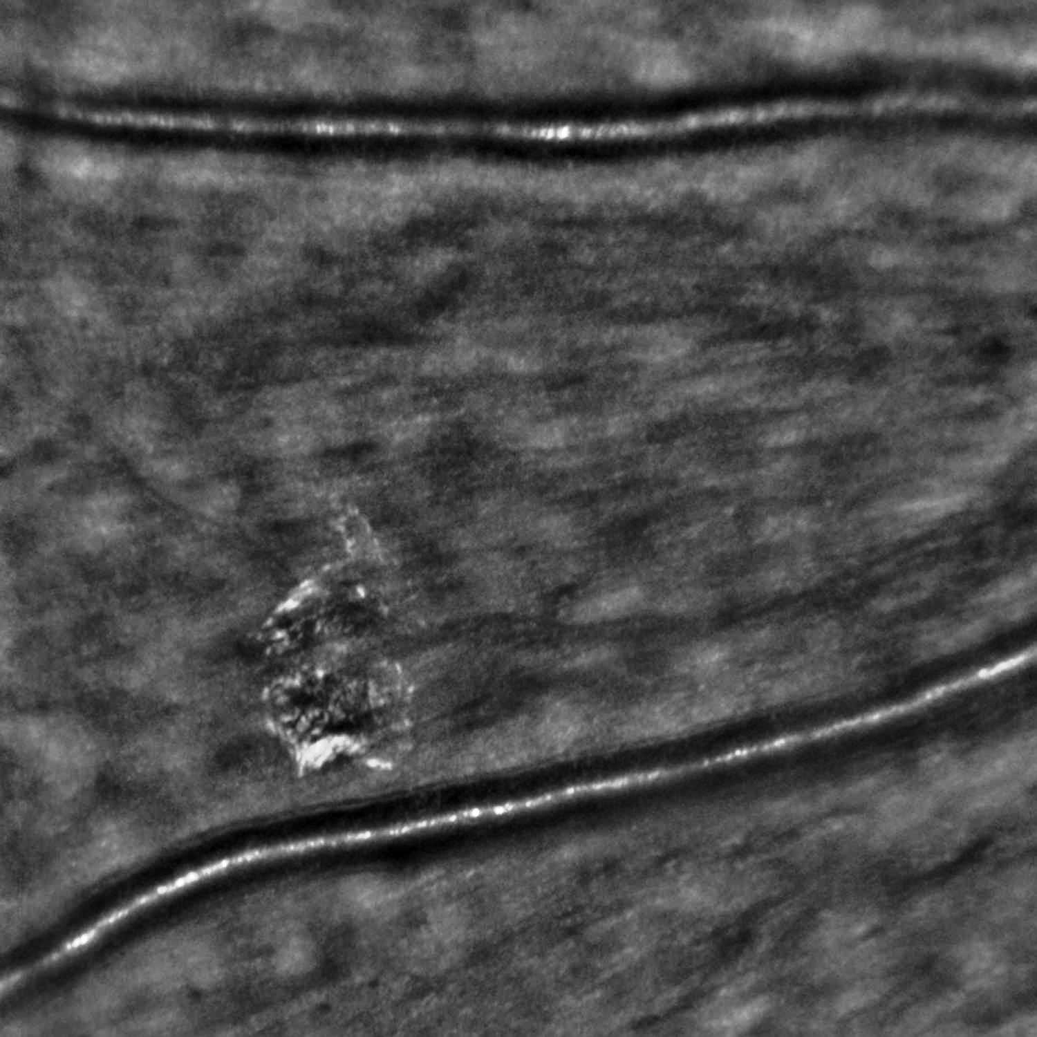 Hard exudate. THe image was acquired while focussing on the retinal blood vessels. Courtesy Dr Kiyoko Gocho, Nippon Medical School Hokusoh Hospital, Chiba, Japan.