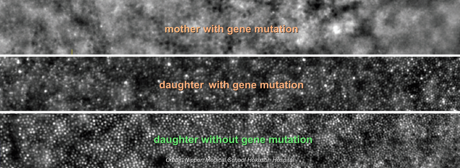 Adaptive optics images of eyes with and without mutation in the HK1 gene causing retinitis pigmentosa